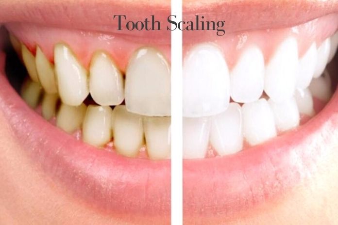 All You Need To Know About Tooth Scaling