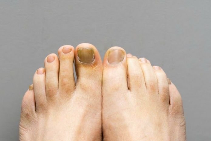 What Is Nail Fungus