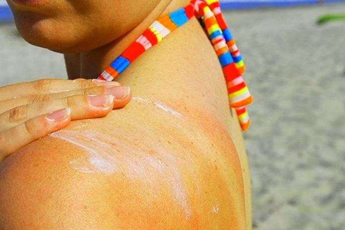 Sun Allergy How To Prevent, Protect, And Treat It