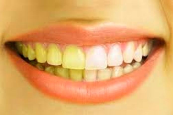 Nine Natural Remedies To Prevent Yellow Teeth