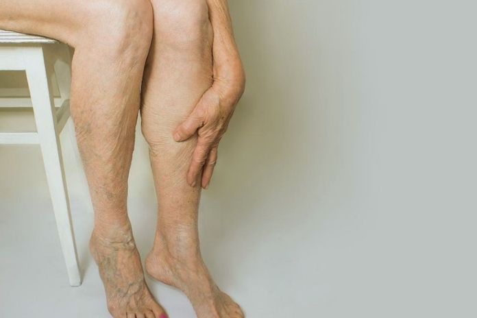 Varicose Veins