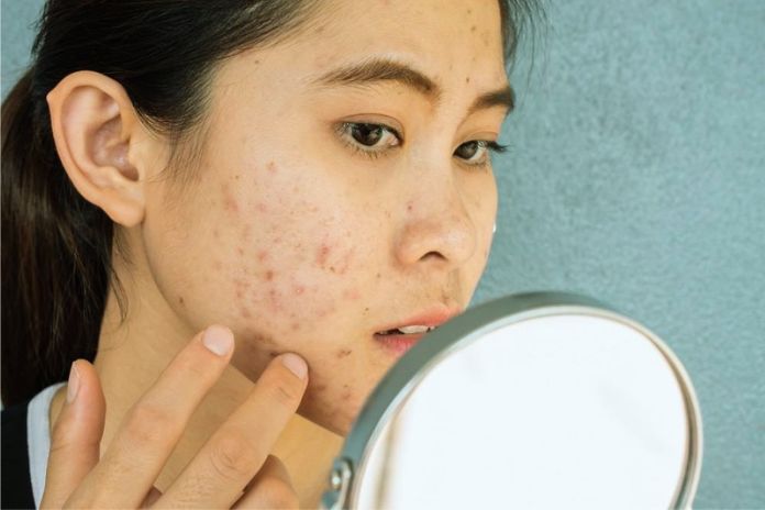 12 Foods To Prevent Pimples And Blackheads