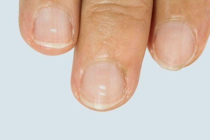 Hair Loss And Weak Nails: Causes, Treatments