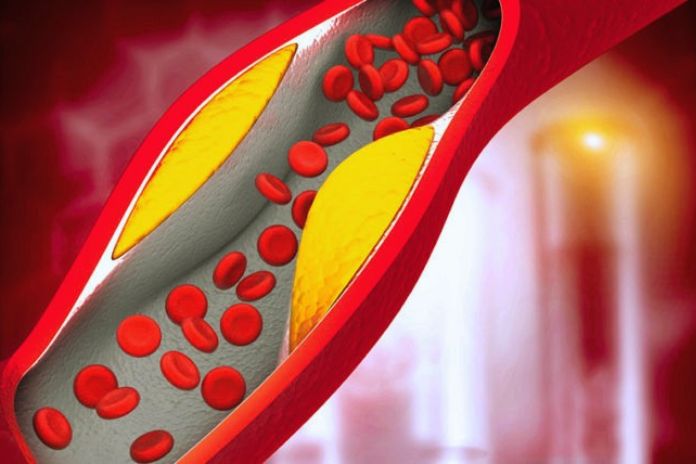 High Cholesterol: Symptoms And What Can Cause It