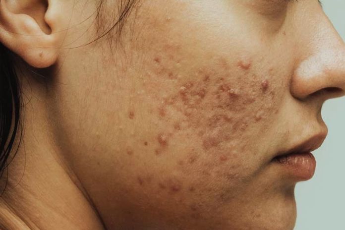 Acne What Is It & How To Treat